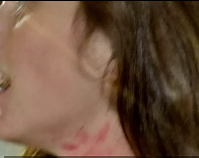 צווארה של תורג'מן לאחר התקיפה