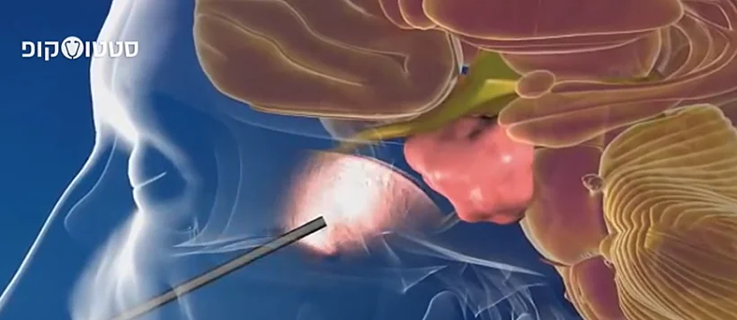 הדמיית גידול ההיפופיזה