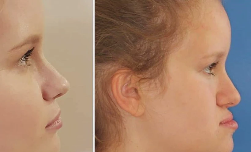 איה לפני ואחרי הניתוח האורתוגנטי