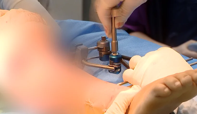 רגלה של אושר במהלך הניתוח