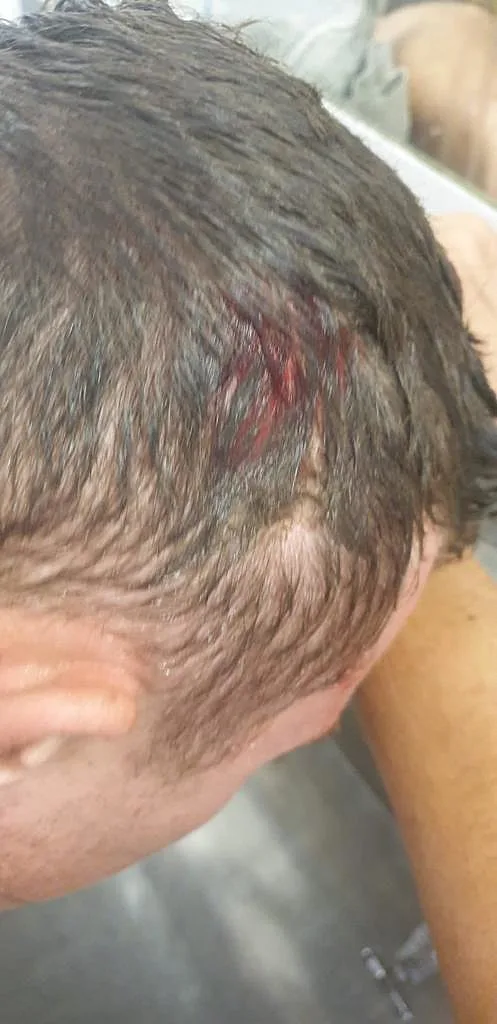 החבלה בראשו של דניאל מארדר שנגרמה מאבן שנזקרה בזמן משחק