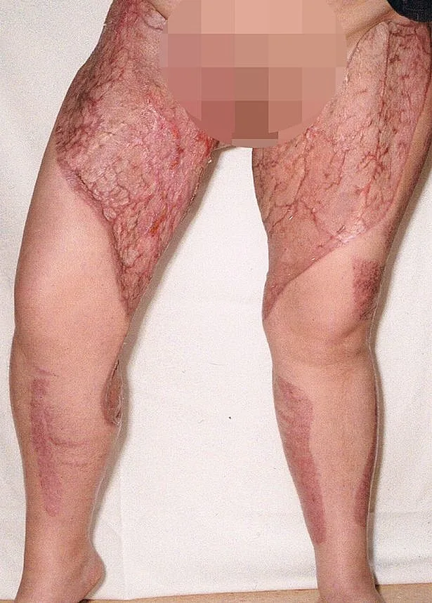 זהירות תמונות קשות: גילחה את שיערה וכמעט איבדה את רגליה