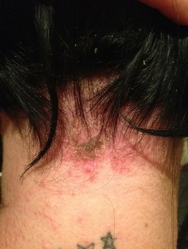 כמעט איבדה את חייה בגלל צבע לשיער