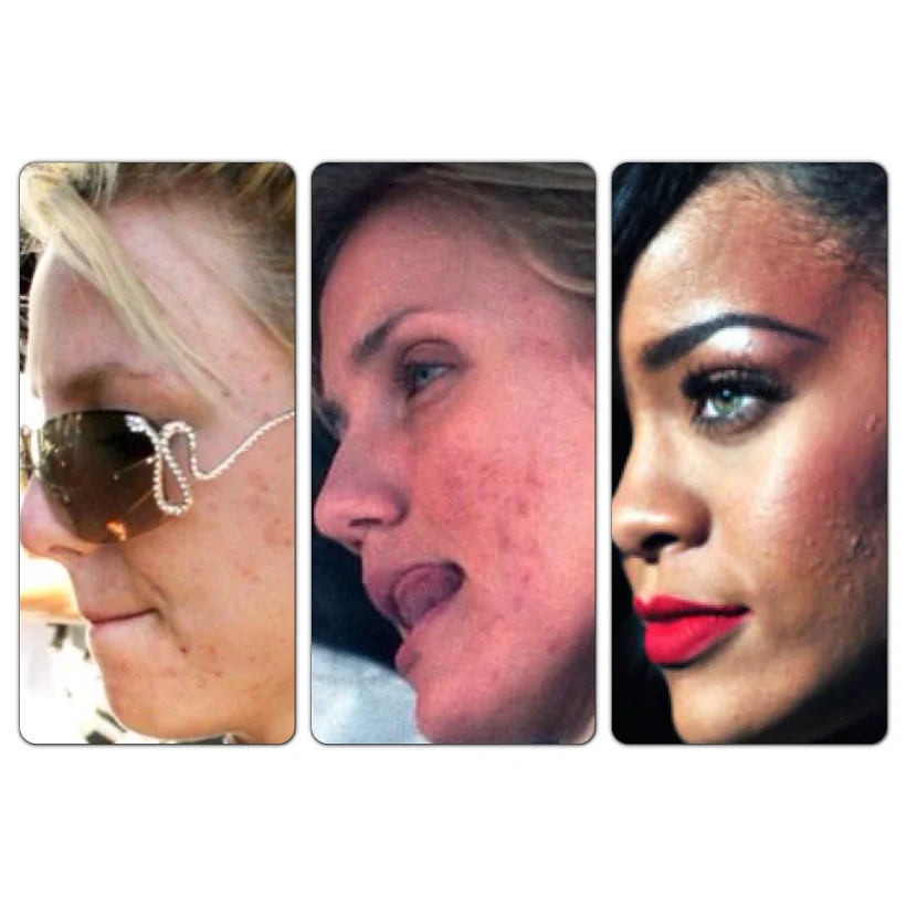 אקנה אצל מפורסמות