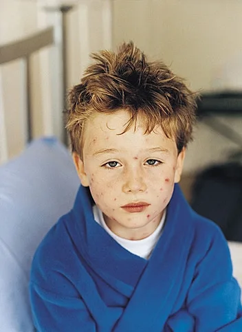 ילדה חולה באבעבועות רוח