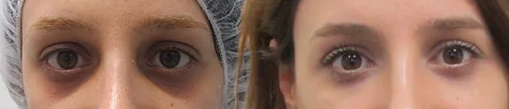 בעזרת מילוי השקעים נוצר מראה עור אחיד