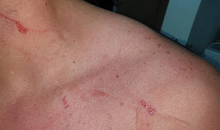 חבלות על גופו של מקסים טל, שלטענת משפחתו הותקף ע''י בת זוגו לפני שלפי החשד רצח אותה