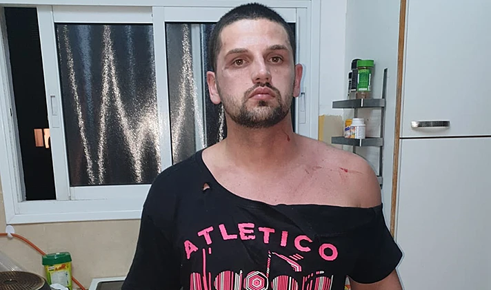חבלות על גופו של מקסים טל, שלטענת משפחתו הותקף ע''י בת זוגו לפני שלפי החשד רצח אותה