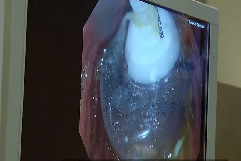 ניתוח הבלון