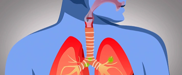 התפשטות נגיף הקורונה בגוף האדם