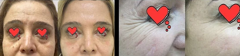 מילוי שקעים והבהרת עור כהה מתחת לעיניים - HD ביוטי