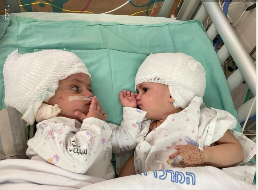 התאומות לאחר הניתוח