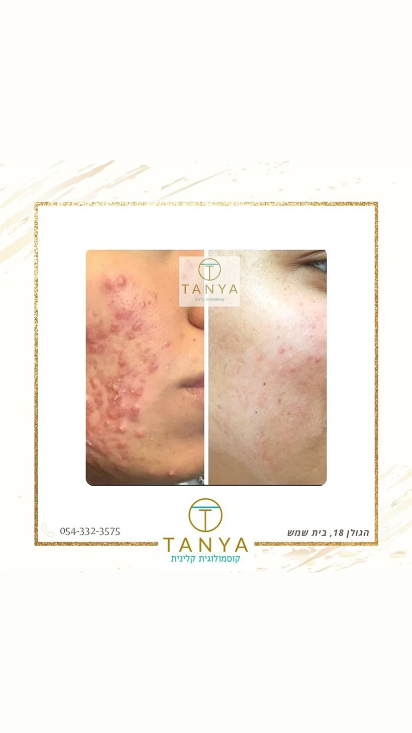 תמונה לפני ואחרי טיפול פנים אצל תניה יוסופוב