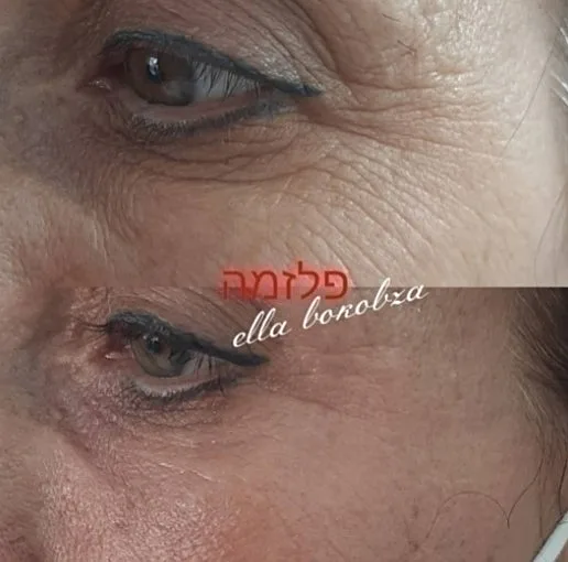 טיפולי פלזמה אצל אלה בוקובזה