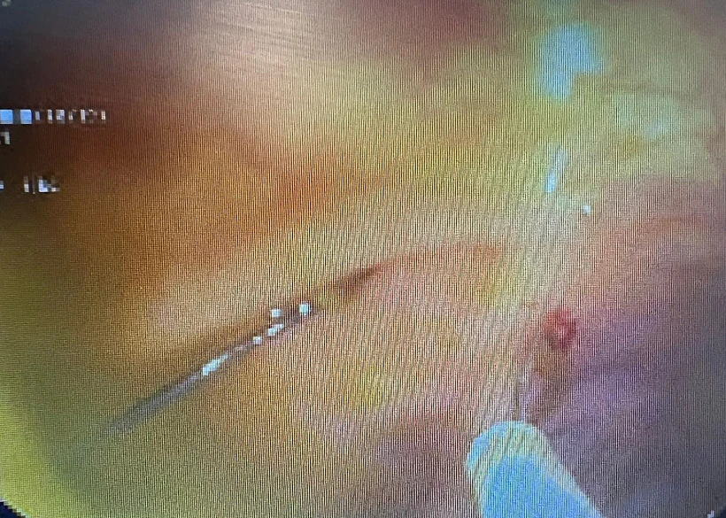 סיכה שהוצאה מגופו של נער בן 14