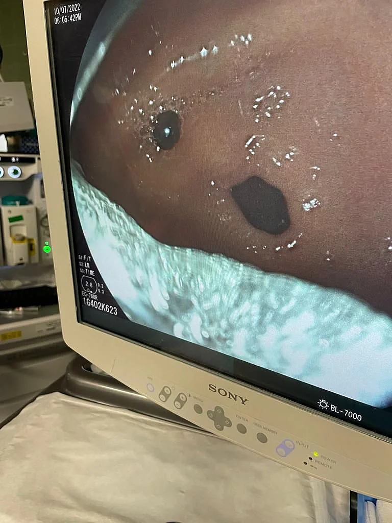 הסיכה שננעצה בדופן קיבתה של נערה