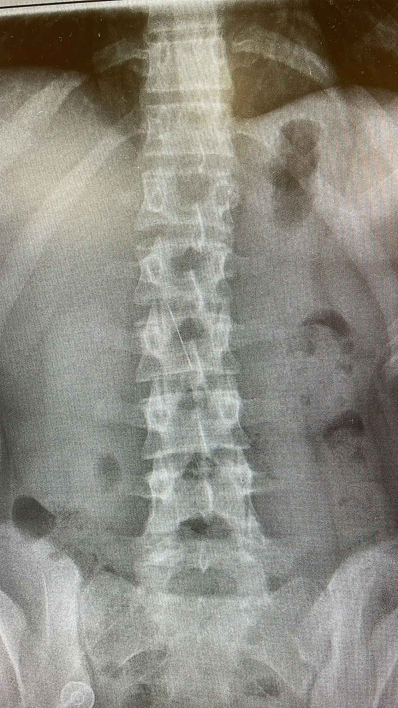 הסיכה שננעצה בדופן קיבתה של נערה