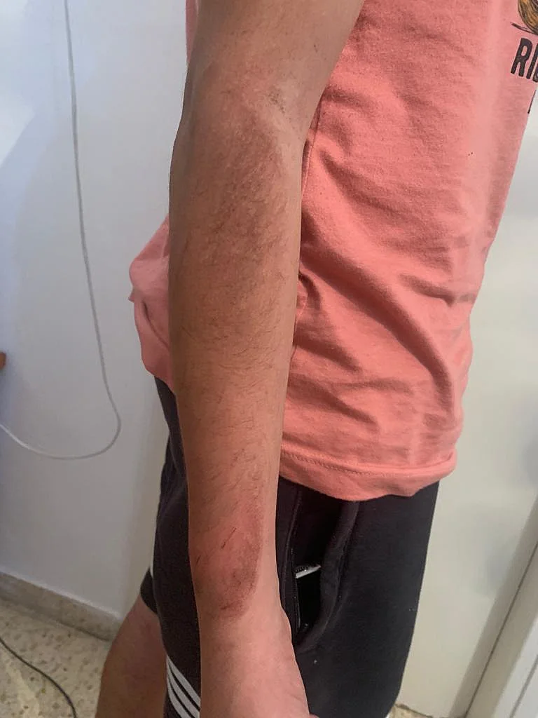 החבלות של בן ה-15 שהותקף