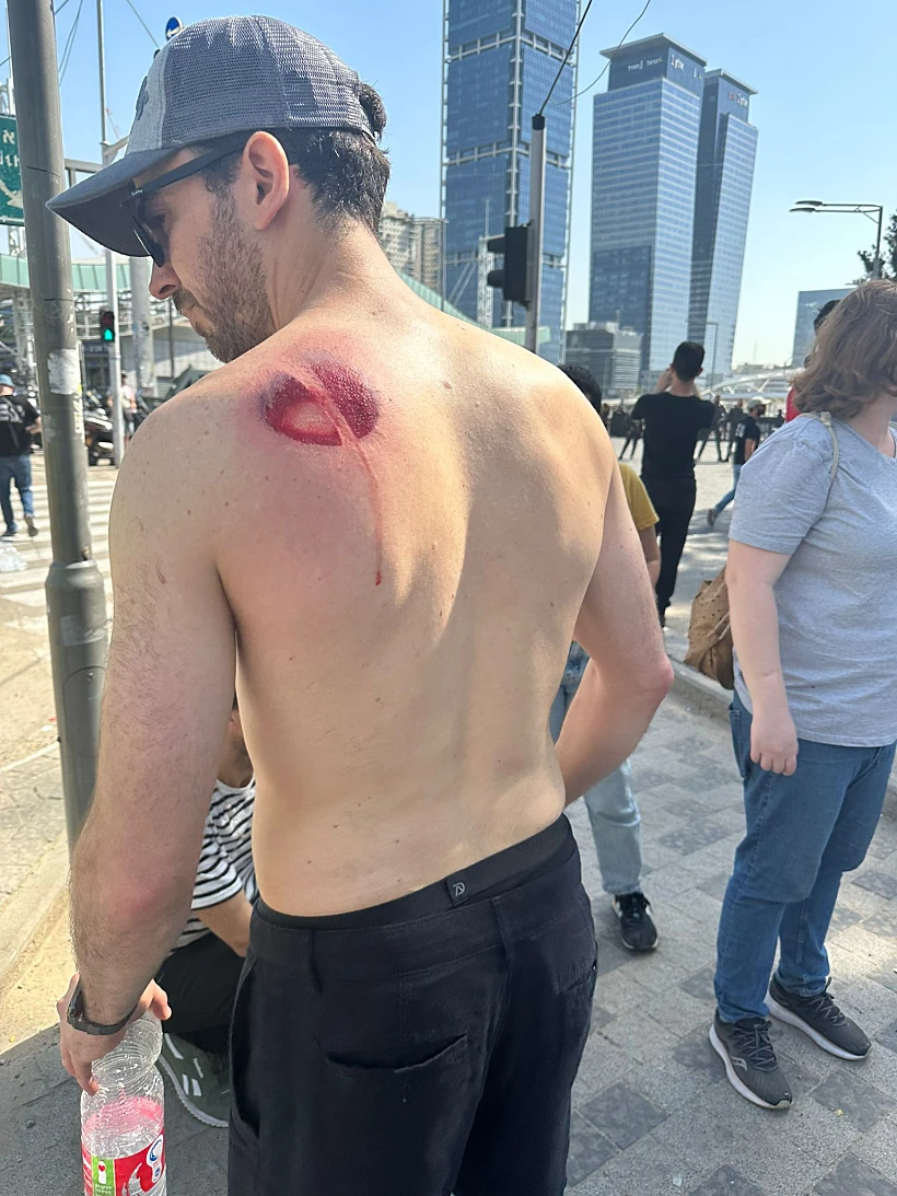 הפגין ונפגע מרימון הלם