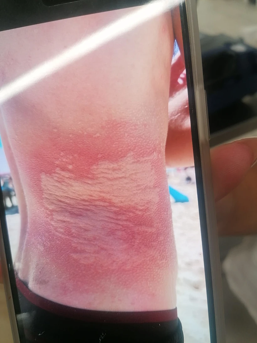 הצעיר שנפגע ממדוזה