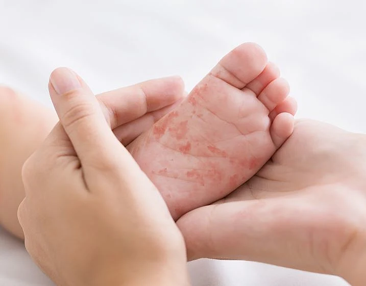 תסמיני חצבת. אילוסטרציה