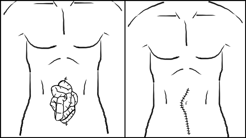 Bowel Evisceration