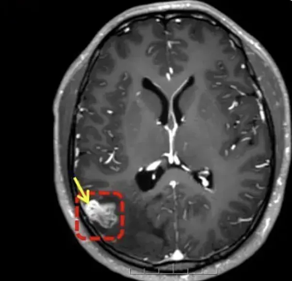 אכל כיס מרה של נחש ונדבק בתולעת טפילית במח