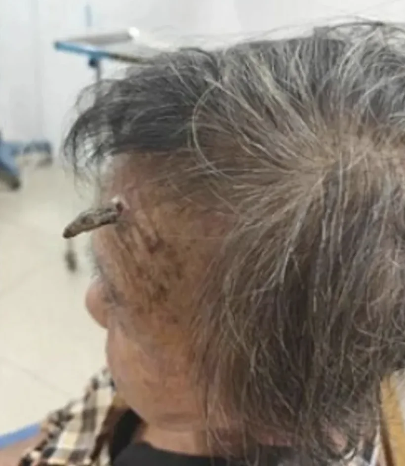 קשישה הסירה בעצמה קרן שצמחה לה על המצח