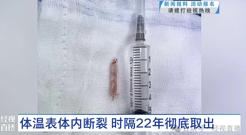 שבר המדחום שהוסר מעכוזה של המטופלת