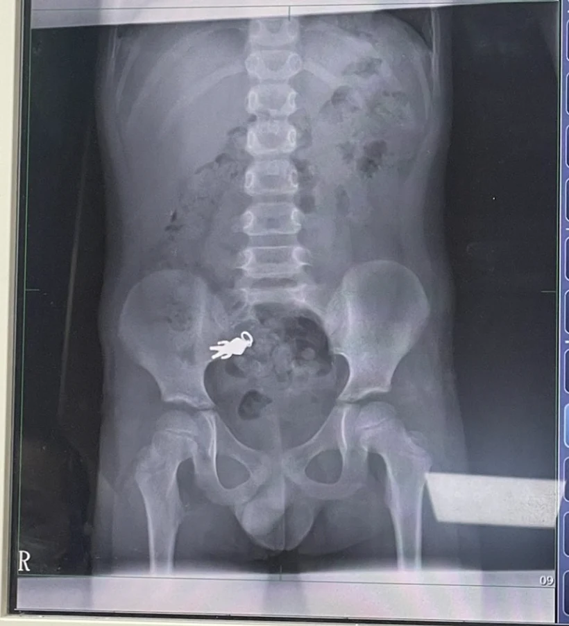 צילום רנטגן