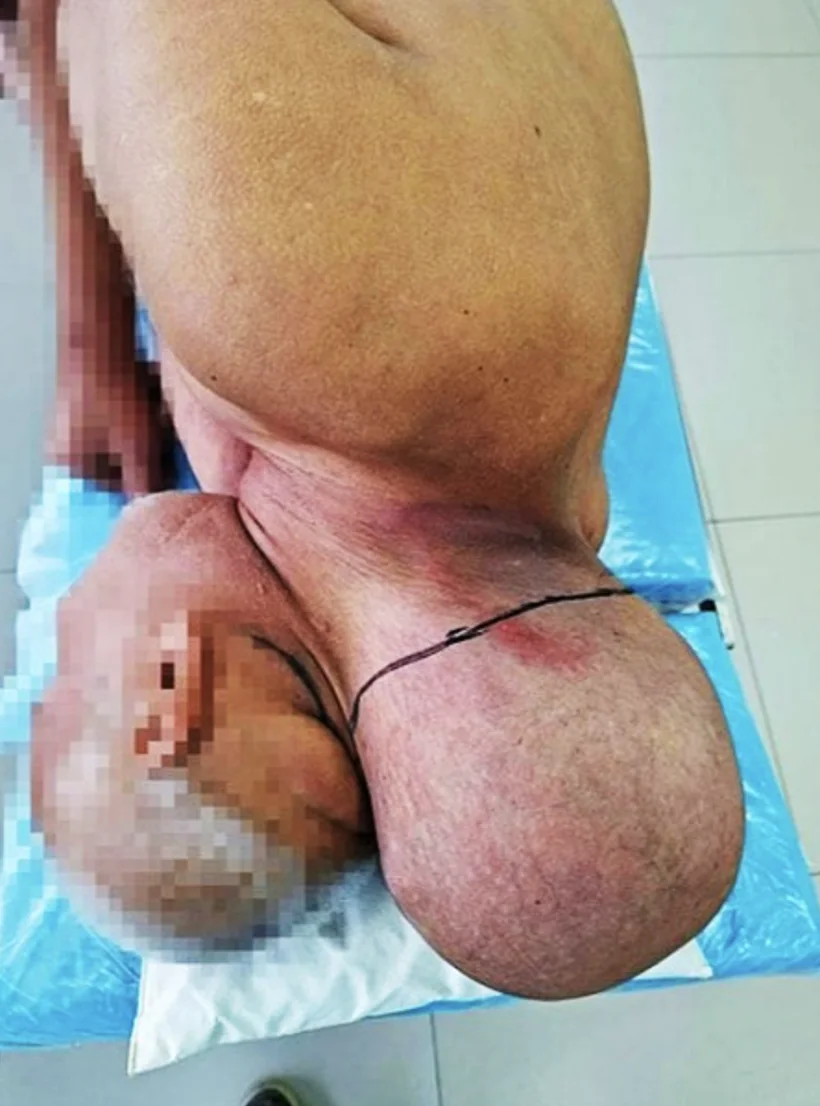 הגידול שצמח על צווארו של המטופל