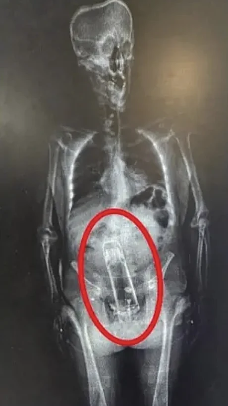 צילום הרנטגן של וולטר פרימר