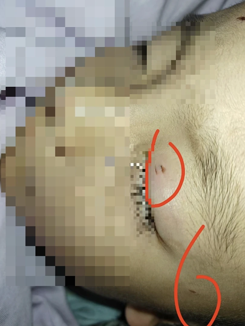 הילד בן ה-5 שנפצע בעינו