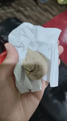 הגאזה שנשכח בגופה של האישה