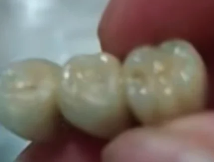 Teeth1