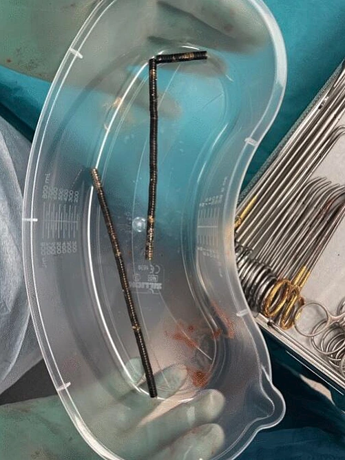 המגנטים שחולצו מגופו של הנער