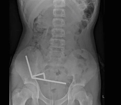 צילום הרנטגן של הנער שבלע מגנטים