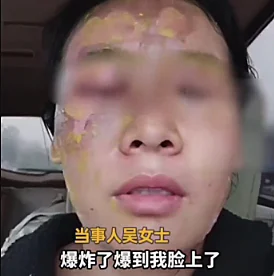 ניסתה לנקות אבנית ונכוותה בפניה