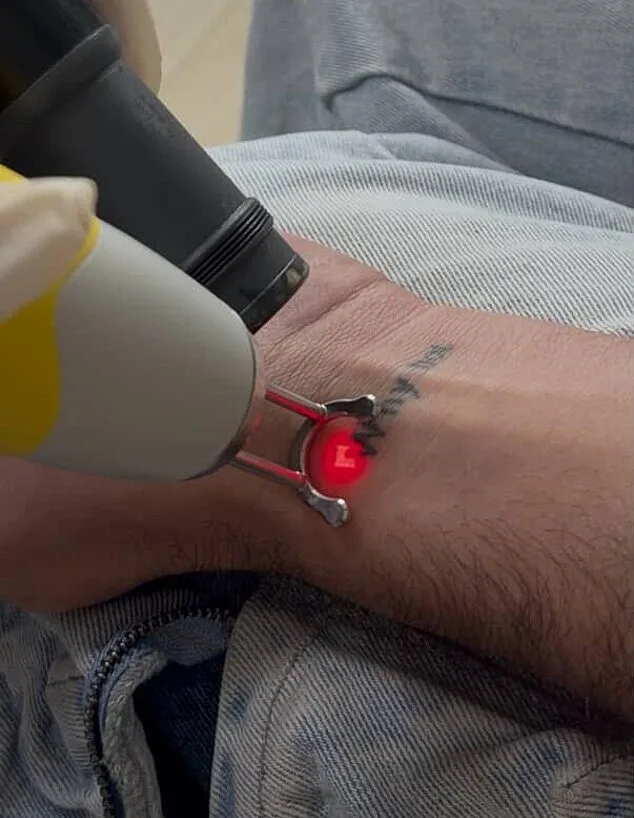 הסרת הקעקוע של חן קראוניק