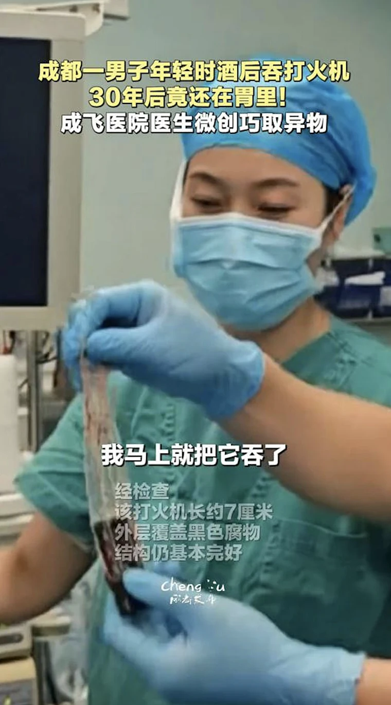 רופאים הסירו מצית שנבלעה לפני 30 שנה