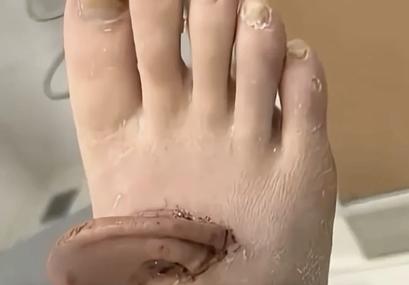 רופאים השתילו אוזן על כף רגלה של מטופלת