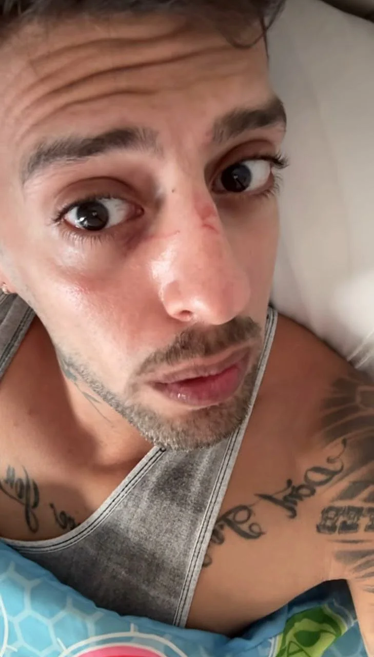 בן אל תבורי מציג את הפציעה בפניו