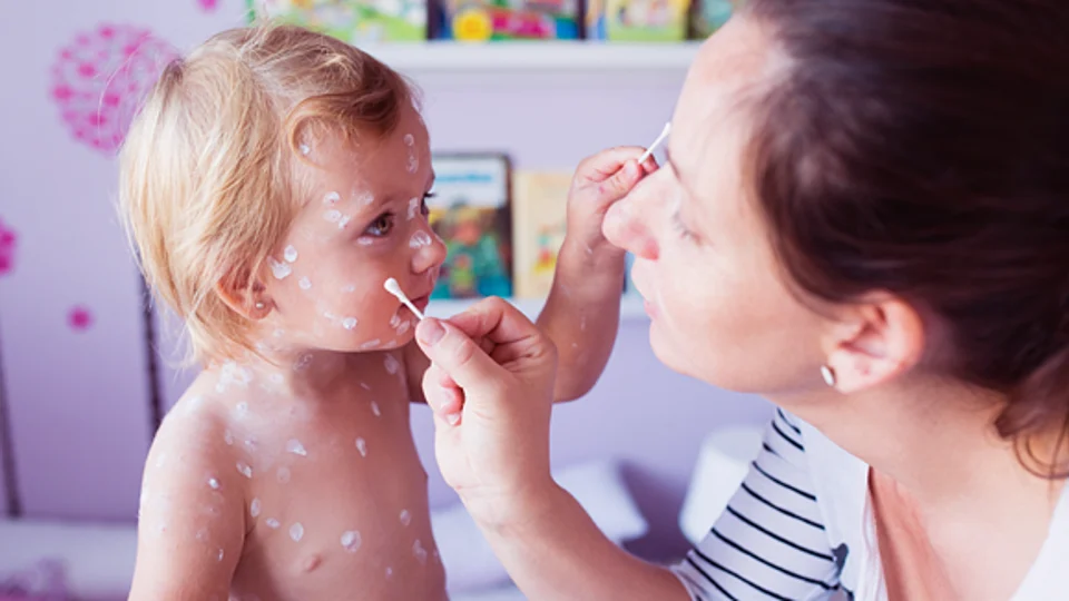 אבעבועות רוח