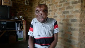 "האיש המכוער באוגנדה" - ננטש על ידי אמו והפך לכוכב פופ מצליח