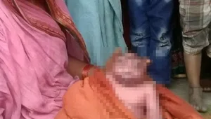 "תינוק חייזר" נולד עקב שילוב תסמונות נדירות