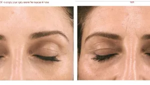 קרם חדשני יעלים את הקמטים