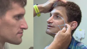 "הייתי נחנק בלילות": הניתוח שמשנה את פני המטופלים ואת חייהם