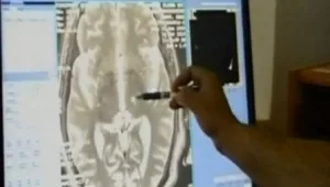 חיים בריא: ככל החידושים בטיפול בפרקינסון