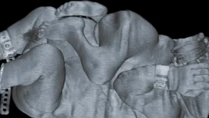 חיים בריא: הפרדת תאומים סיאמיים