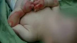 חיים בריא: מה צריך להיות הטיפול המיידי במצב של כוויה?